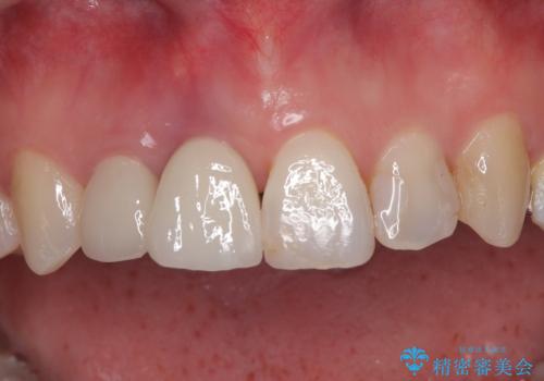 破折した前歯のインプラント 1DAYインプラントで短期間治療の症例 治療後