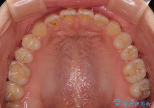 前歯のオープンバイト インビザラインで咬み合わせを改善の治療後