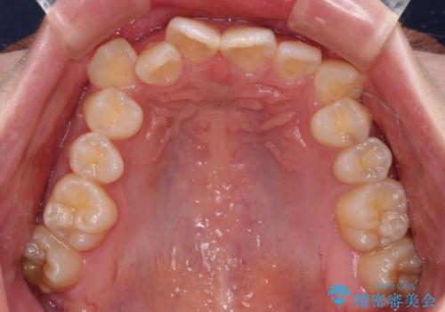 気になる八重歯 ワイヤー装置での抜歯矯正の治療前