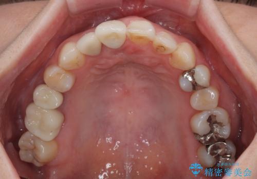 破折した前歯のインプラント 1DAYインプラントで短期間治療の治療後