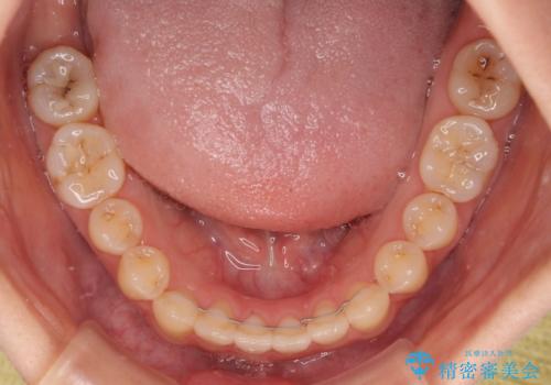 前歯のオープンバイト インビザラインで咬み合わせを改善の治療後