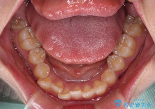 気になる八重歯 ワイヤー装置での抜歯矯正の治療前