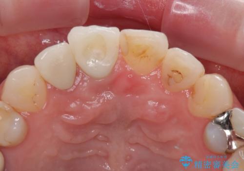 破折した前歯のインプラント 1DAYインプラントで短期間治療の治療後