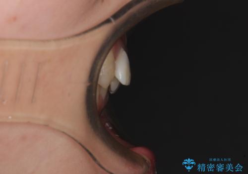 気になっていたむし歯と前歯のデコボコ 矯正治療とむし歯治療の総合歯科治療の治療前