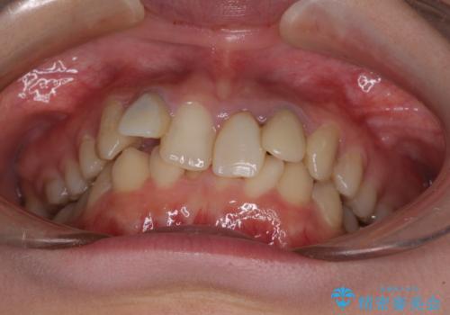 気になっていたむし歯と前歯のデコボコ 矯正治療とむし歯治療の総合歯科治療の治療前