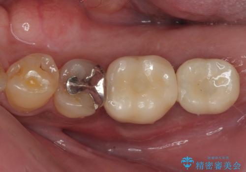 咬合力で破折した奥歯 抜歯即時インプラントで短期間治療の症例 治療後