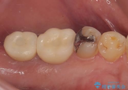 咬合力で破折した奥歯 抜歯即時インプラントで短期間治療の治療後