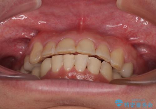 銀歯を白くしたい 一緒に矯正治療も行ない美しい口腔内にの治療後