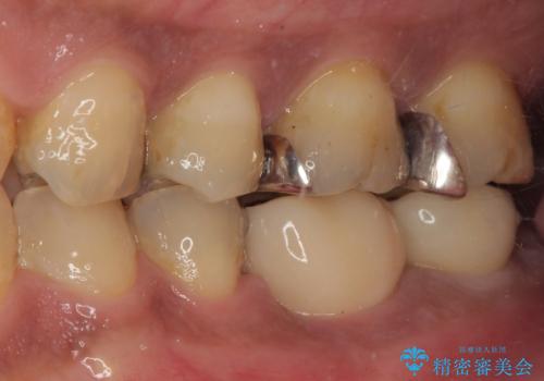 咬合力で破折した奥歯 抜歯即時インプラントで短期間治療の治療後