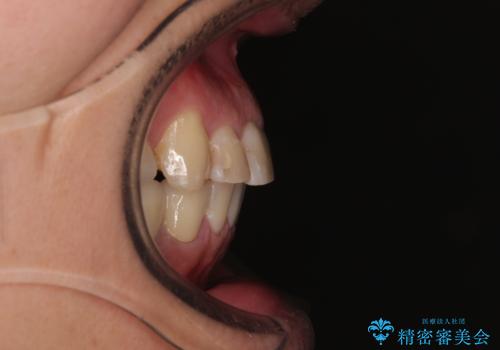 銀歯を白くしたい 一緒に矯正治療も行ない美しい口腔内にの治療後