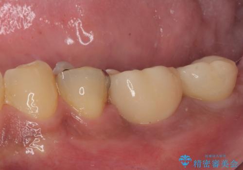 咬合力で破折した奥歯 抜歯即時インプラントで短期間治療の治療後