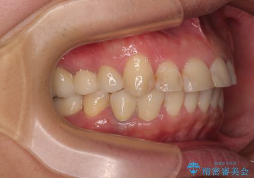 銀歯を白くしたい 一緒に矯正治療も行ない美しい口腔内にの治療後
