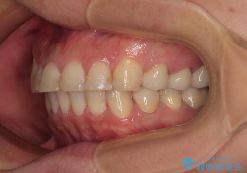 銀歯を白くしたい 一緒に矯正治療も行ない美しい口腔内にの治療後