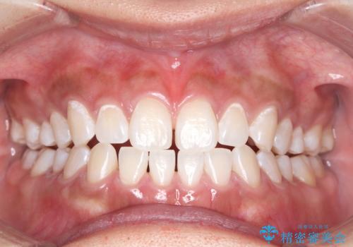 結婚式前のオフィスホワイトニングの症例 治療後