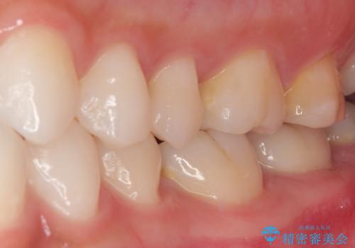 レジンが劣化してきた オールセラミッククラウンの治療前