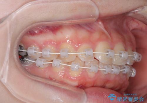 気になる前歯を矯正 短期間のワイヤー矯正治療の治療中
