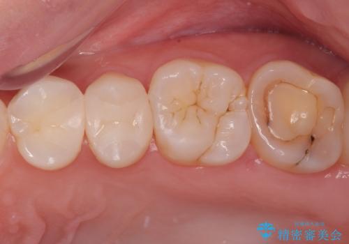 レジンが劣化してきた オールセラミッククラウンの症例 治療前