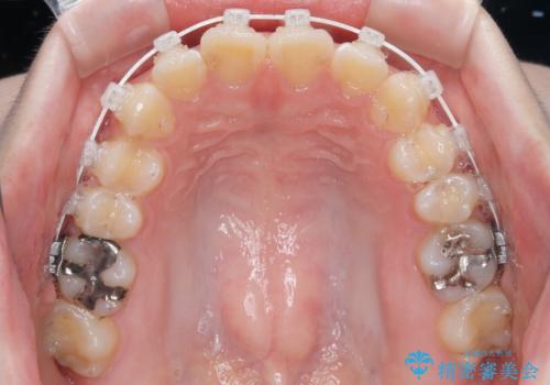 気になる前歯を矯正 短期間のワイヤー矯正治療の治療中