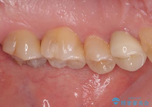 奥歯の大きなむし歯 神経を残してセラミック治療の治療前