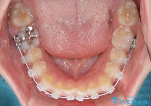 気になる前歯を矯正 短期間のワイヤー矯正治療の治療中