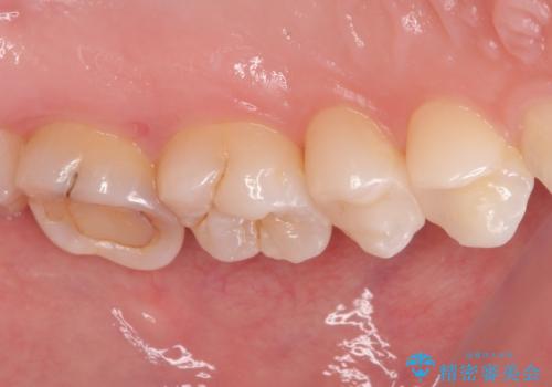 レジンが劣化してきた オールセラミッククラウンの治療前