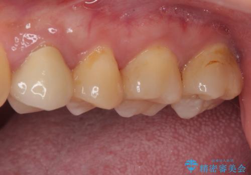 奥歯の大きなむし歯 神経を残してセラミック治療の治療前