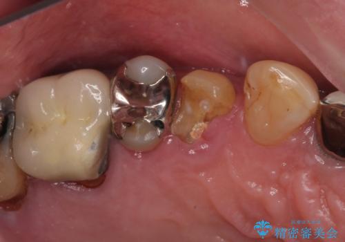 抜歯は避けたい? 1DAYインプラントに魅せられて抜歯即時埋入インプラントによる補綴治療の症例 治療前