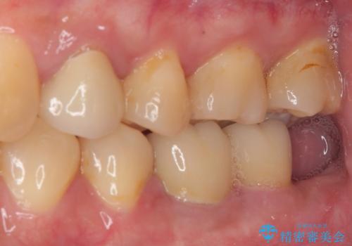奥歯の大きなむし歯 神経を残してセラミック治療の治療前