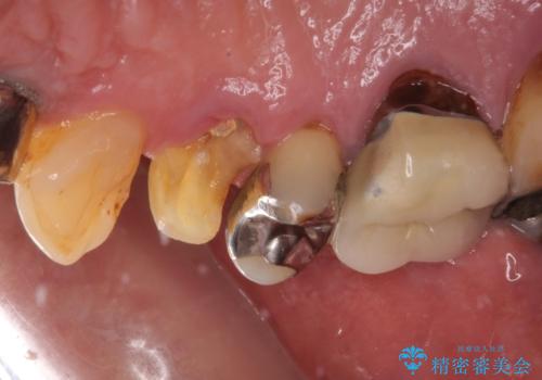 抜歯は避けたい? 1DAYインプラントに魅せられて抜歯即時埋入インプラントによる補綴治療の治療前