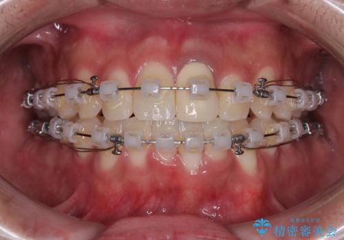 気になる前歯のデコボコと八重歯 ワイヤー矯正ですっきりとの治療中