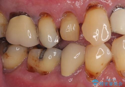 抜歯は避けたい? 1DAYインプラントに魅せられて抜歯即時埋入インプラントによる補綴治療の治療前