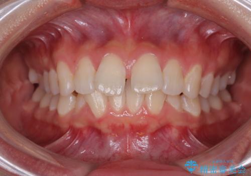 深い咬み合わせによる隙間 インビザライン矯正でコンプレックスを改善の症例 治療前
