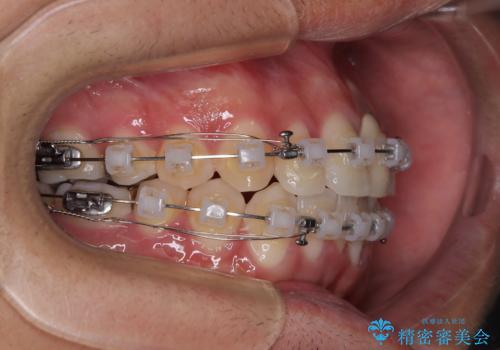 気になる前歯のデコボコと八重歯 ワイヤー矯正ですっきりとの治療中