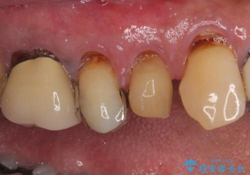 抜歯は避けたい? 1DAYインプラントに魅せられて抜歯即時埋入インプラントによる補綴治療の治療前