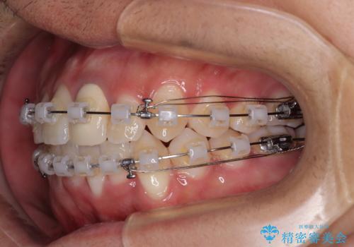 気になる前歯のデコボコと八重歯 ワイヤー矯正ですっきりとの治療中