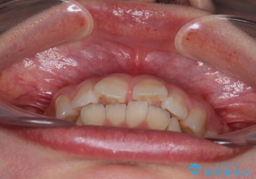 深い咬み合わせによる隙間 インビザライン矯正でコンプレックスを改善の治療前