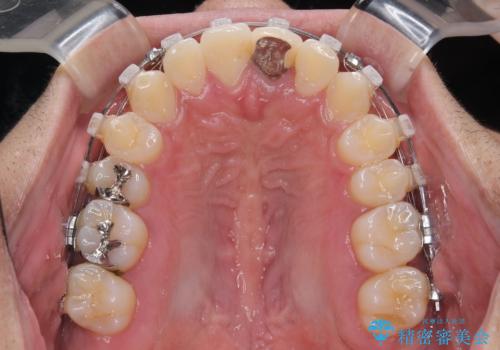 気になる前歯のデコボコと八重歯　ワイヤー矯正ですっきりとの治療中