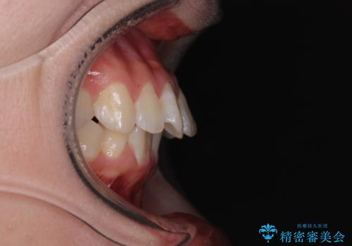 深い咬み合わせによる隙間 インビザライン矯正でコンプレックスを改善の治療前