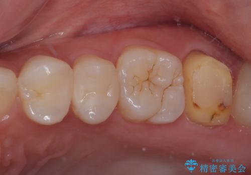 レジンが劣化してきた オールセラミッククラウンの治療中