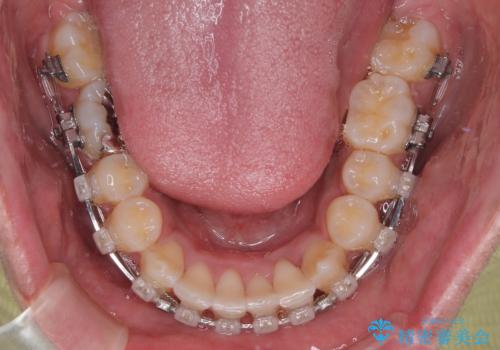 気になる前歯のデコボコと八重歯　ワイヤー矯正ですっきりとの治療中