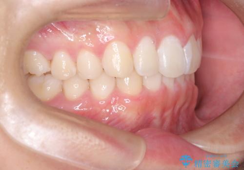 必ずしもワイヤーでなくても大丈夫!インビザラインでデコボコ歯列&過蓋咬合を改善の治療後