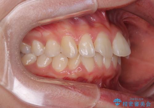 深い咬み合わせによる隙間 インビザライン矯正でコンプレックスを改善の治療前