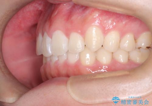 必ずしもワイヤーでなくても大丈夫!インビザラインでデコボコ歯列&過蓋咬合を改善の治療後