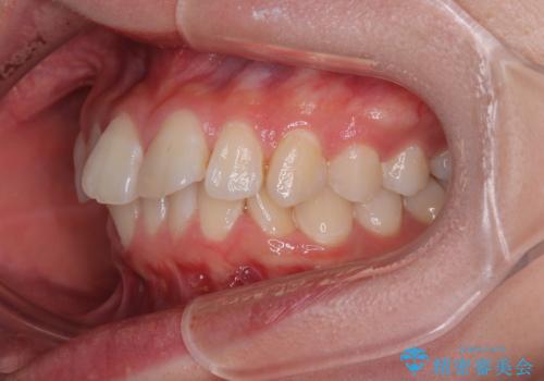 深い咬み合わせによる隙間 インビザライン矯正でコンプレックスを改善の治療前