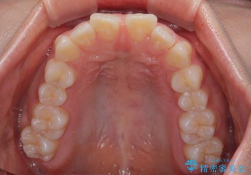 深い咬み合わせによる隙間 インビザライン矯正でコンプレックスを改善の治療前