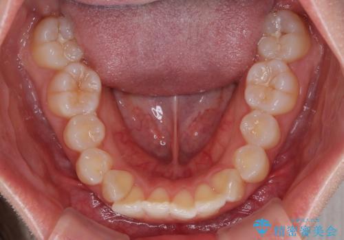 深い咬み合わせによる隙間 インビザライン矯正でコンプレックスを改善の治療前