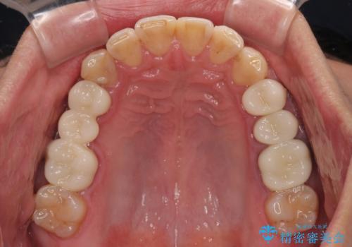 銀歯を白くしたい 一緒に矯正治療も行ない美しい口腔内にの治療後
