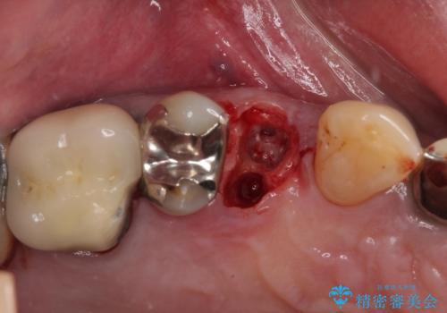 抜歯は避けたい? 1DAYインプラントに魅せられて抜歯即時埋入インプラントによる補綴治療の治療前