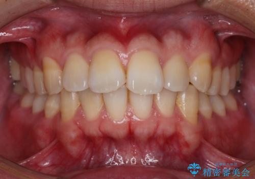 【インビザライン】目立たない矯正で前歯を綺麗にの症例 治療前