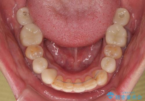 銀歯を白くしたい 一緒に矯正治療も行ない美しい口腔内にの治療後